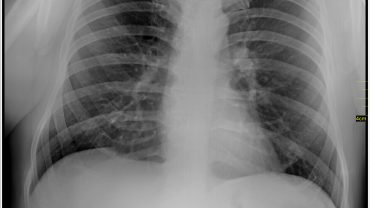 Akciğer Radyolojisi